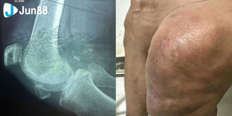 Diễn Viên Thương Tín Bị Vỡ Xương Bánh Chè, Mất Khả Năng Hồi Phục 4 Sự lo lắng của gia đình Thương Tín không chỉ là một chuyện riêng của họ, mà còn được rất nhiều người hâm mộ quan tâm.